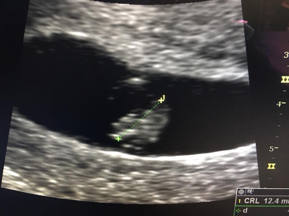 罹癌女病患的超音波檢查中，可看到子宮內有個發育中的胚胎。（翻攝自鄭丞傑醫師健康教室臉書）