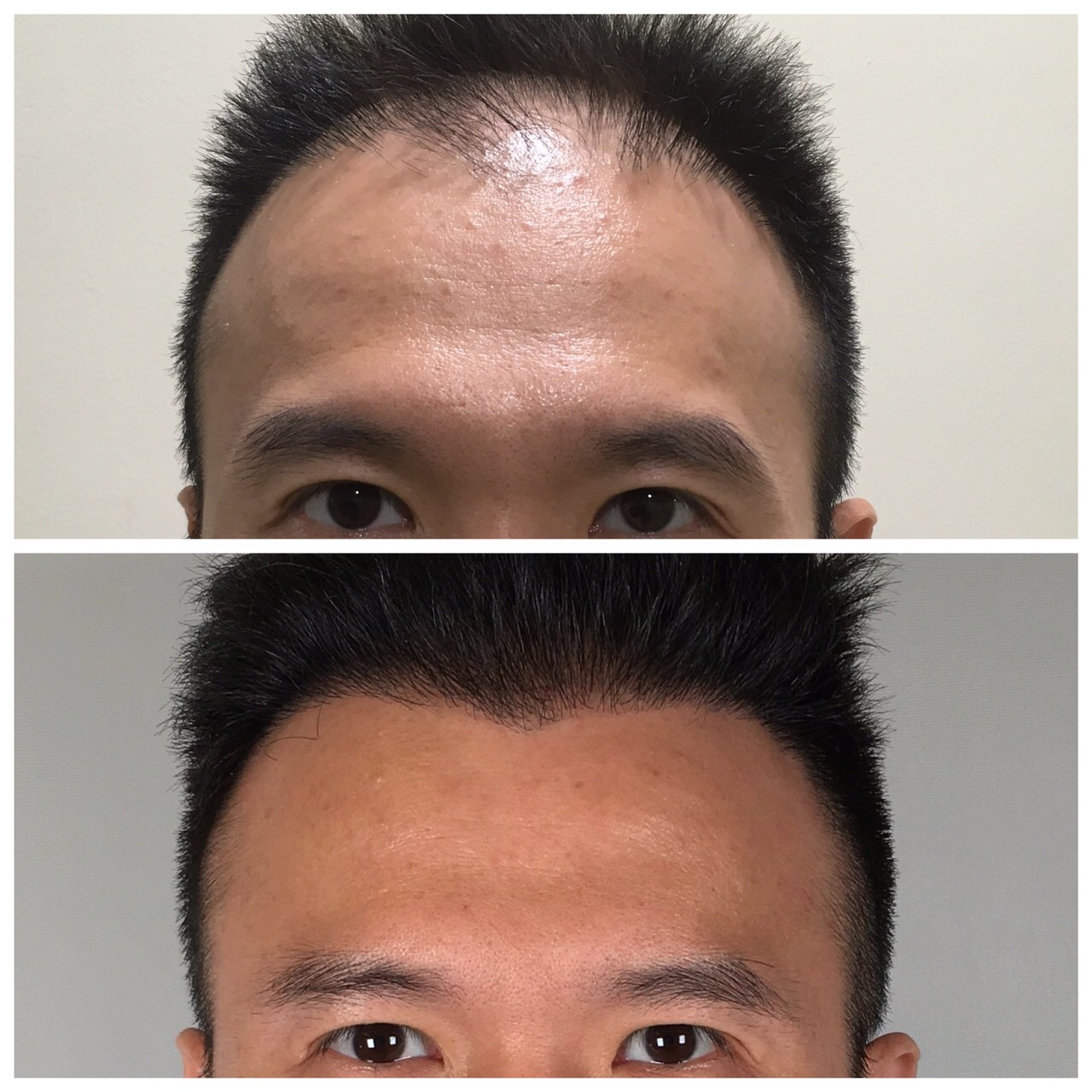 不少男性有雄性禿困擾，李瑞田替乳房專科魏銓延醫師植髮，找回自信心。（曼都集團提供）