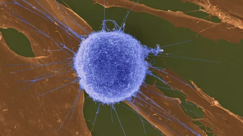 肥胖肺癌中的T細胞。（取自DENNIS KUNKEL）