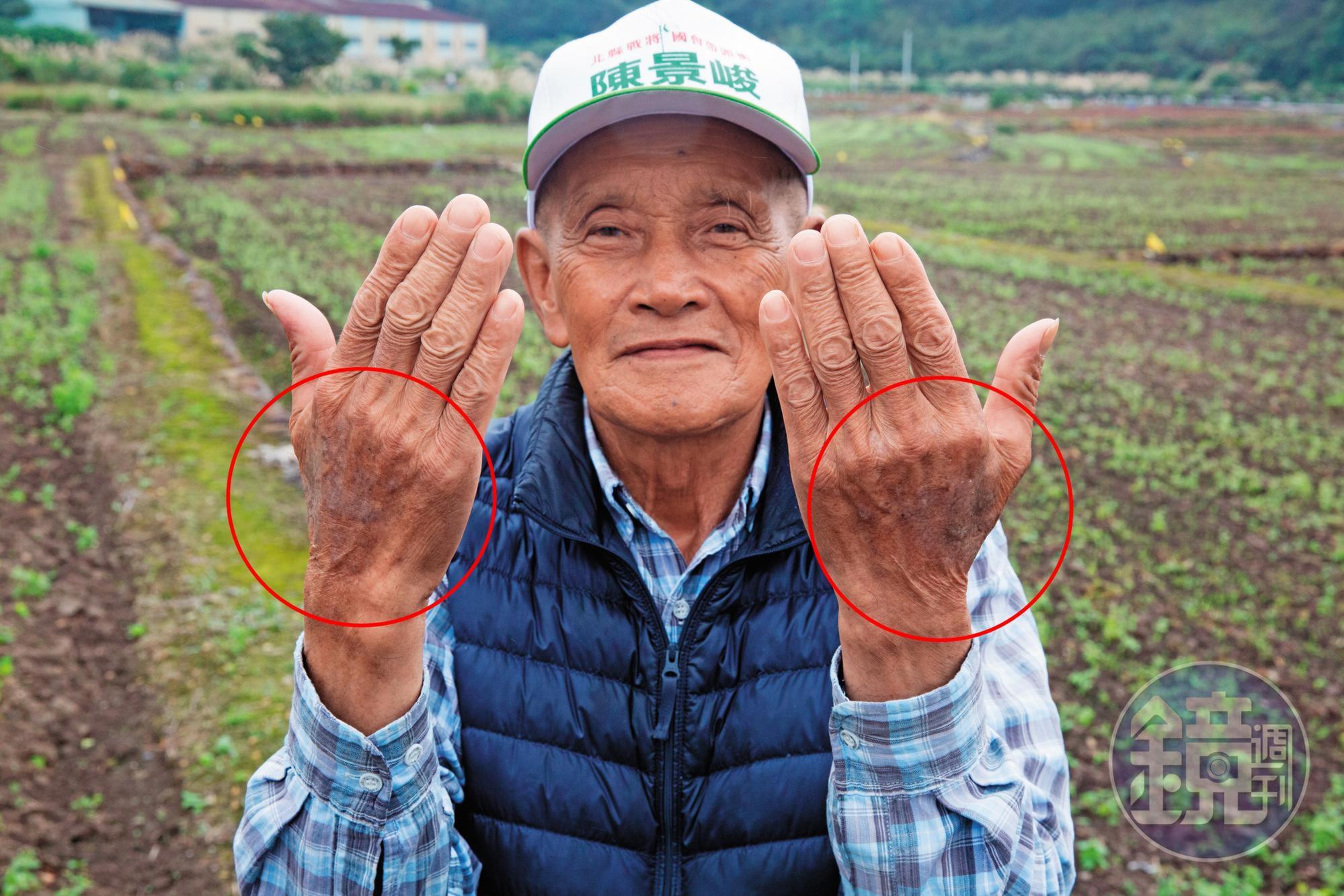 當地老農拔草時被咬，蟻毒在他的手上留下大片黑色斑記，數度就醫都好不了。