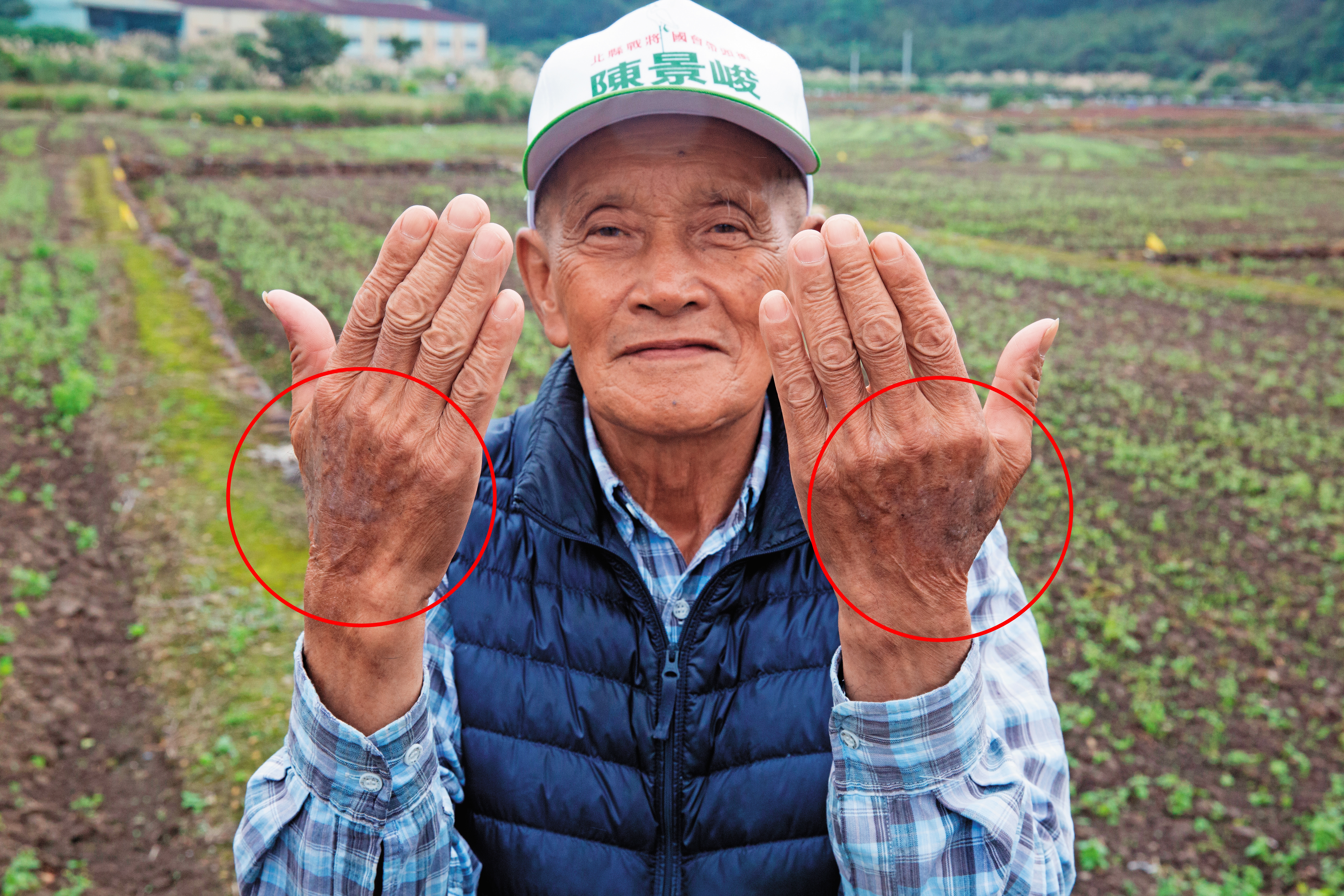 當地老農拔草時被咬，蟻毒在他的手上留下大片黑色斑記，數度就醫都好不了。