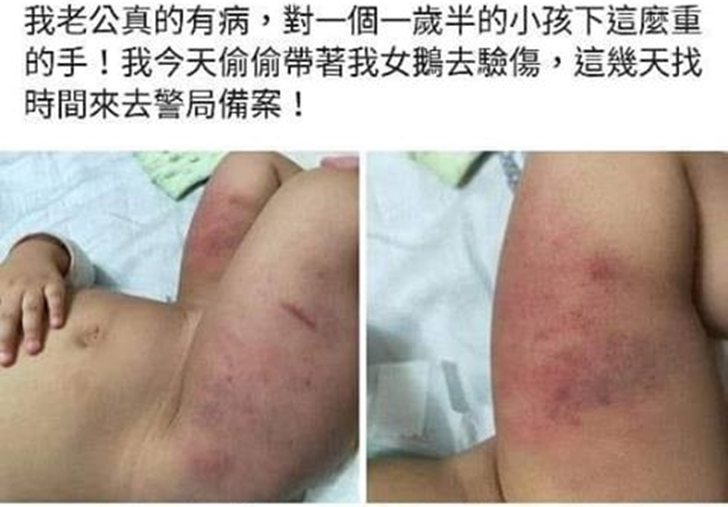 1歲半女童疑似被父親虐打，小小身軀遍體鱗傷。（翻攝網路）