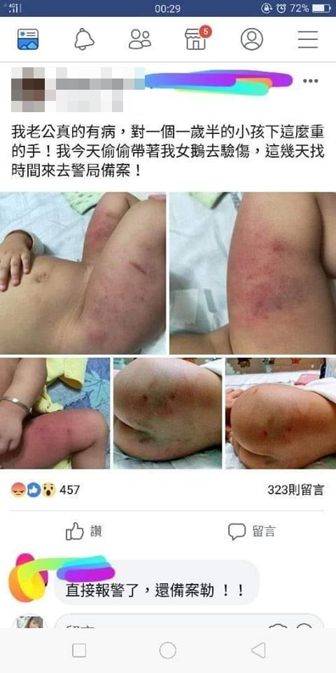 女嬰被打到滿身傷，母親居然不先報警，反而將孩子傷勢放上網路。（翻攝網路）
