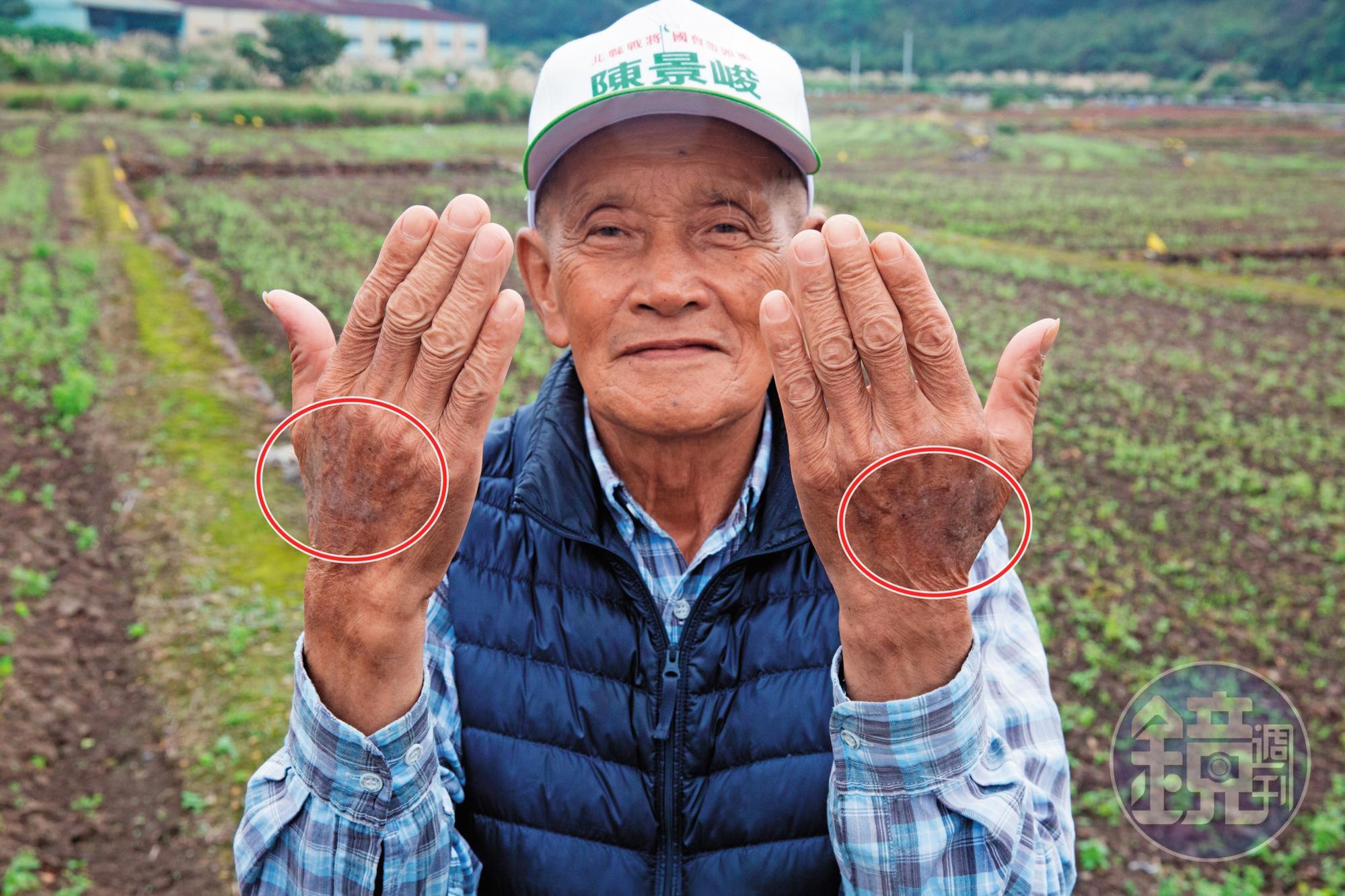 當地老農拔草時被咬，蟻毒在他的手上留下大片黑色斑記，數度就醫都好不了。