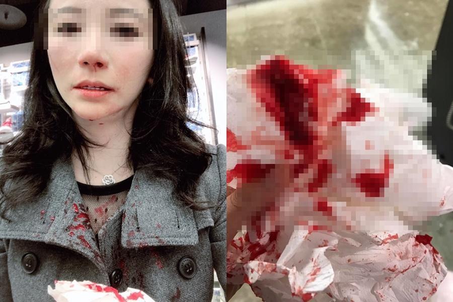 原本面貌清秀可人的鄭女被磚頭扁到鼻血狂流。(翻攝自鄭女臉書)
