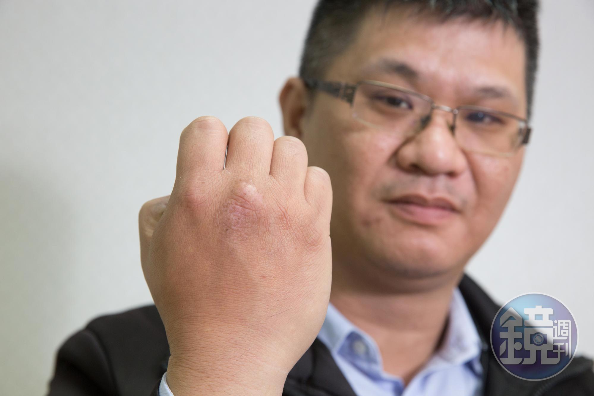 盧致宏手上有一片醒目痕跡,是感染屍毒造成。每到冬天都會龜裂,讓他困擾多年。