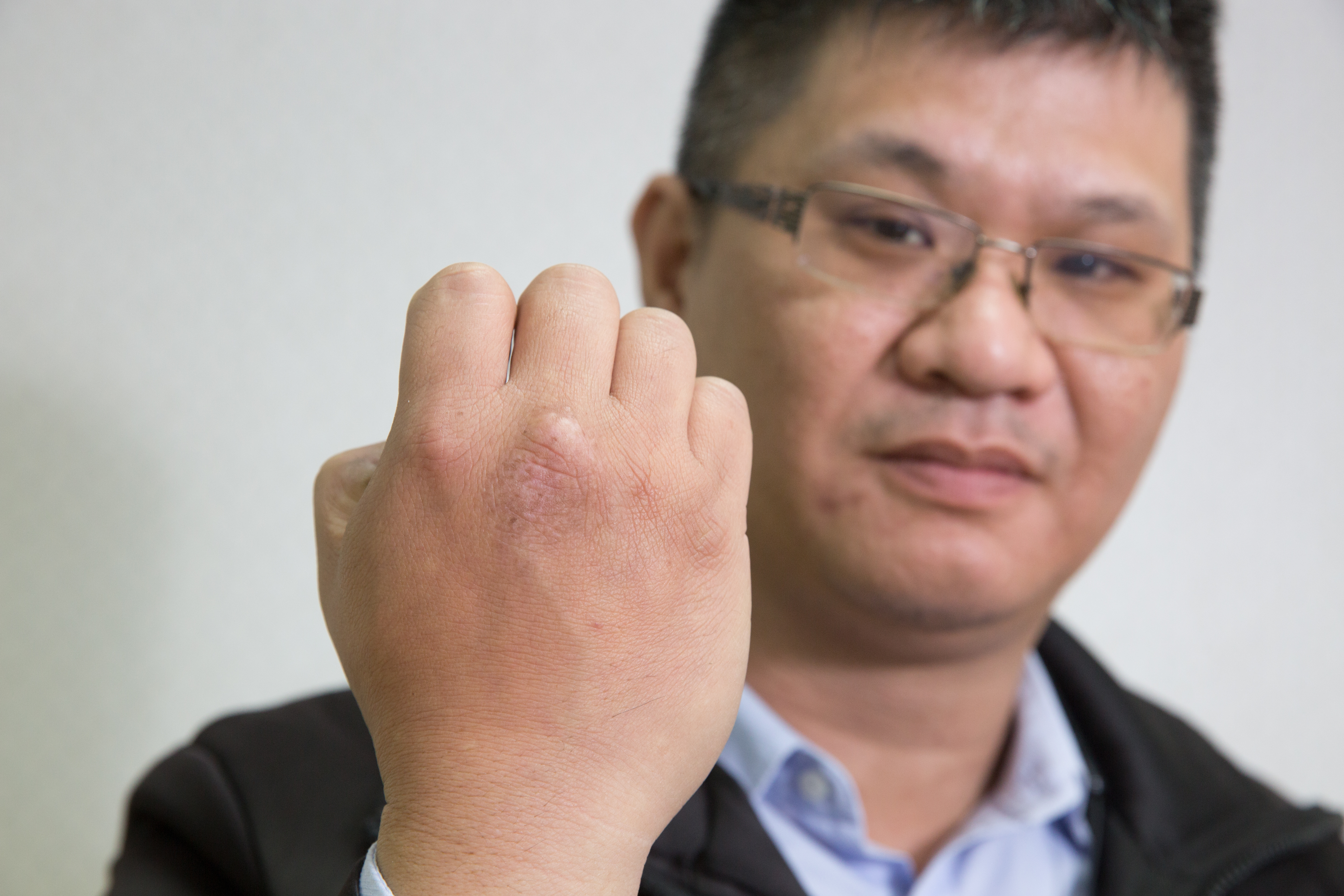 盧致宏手上有一片醒目痕跡，是感染屍毒造成。每到冬天都會龜裂，讓他困擾多年。