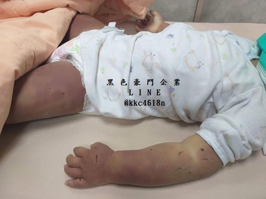 女童身上多處瘀青和結痂,醫護人員懷疑長期遭虐待致死。(黑色豪門提供)