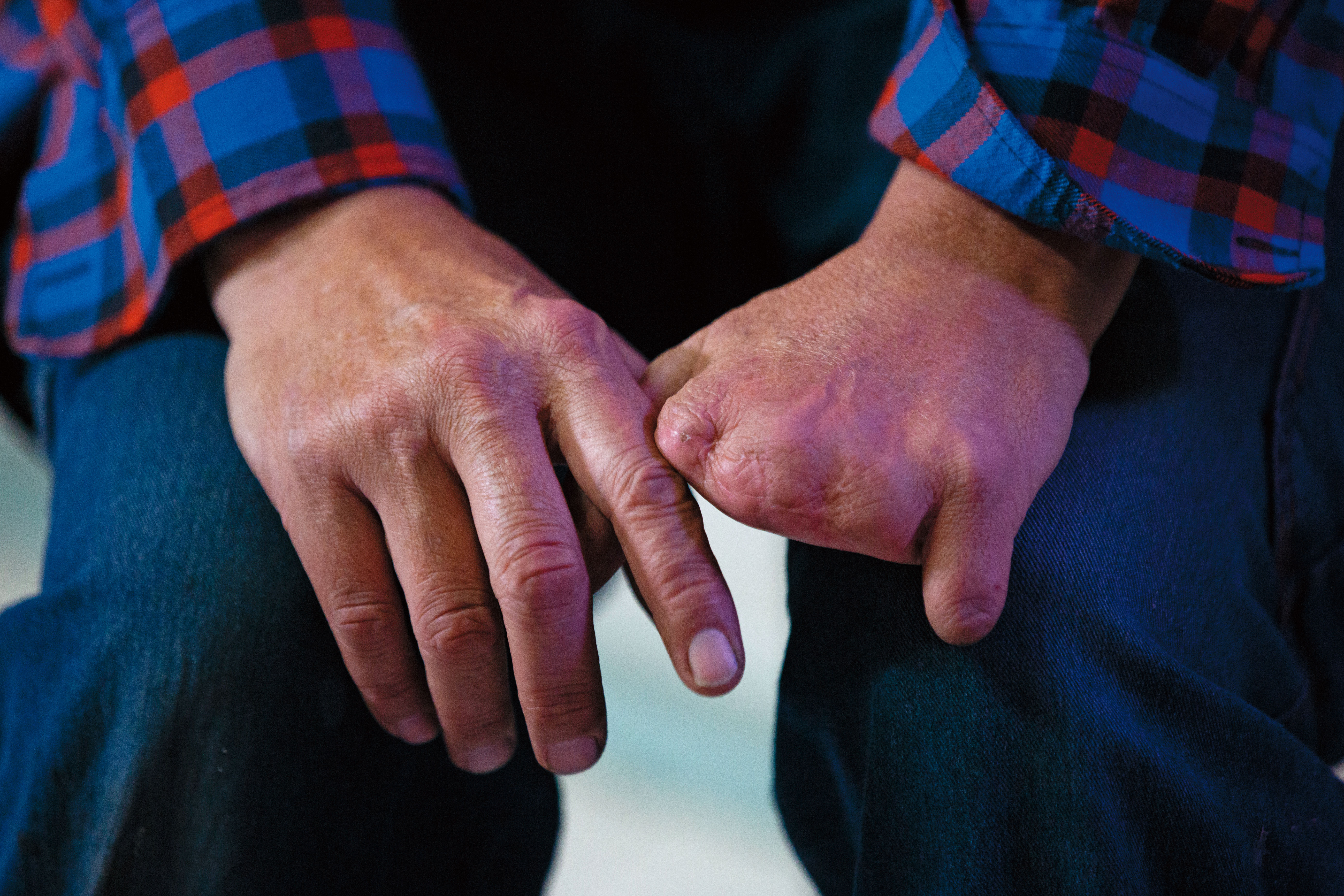 王先生的左手4根手指因醉酒遭絞肉機截斷，心情憂鬱，更借酒澆愁。