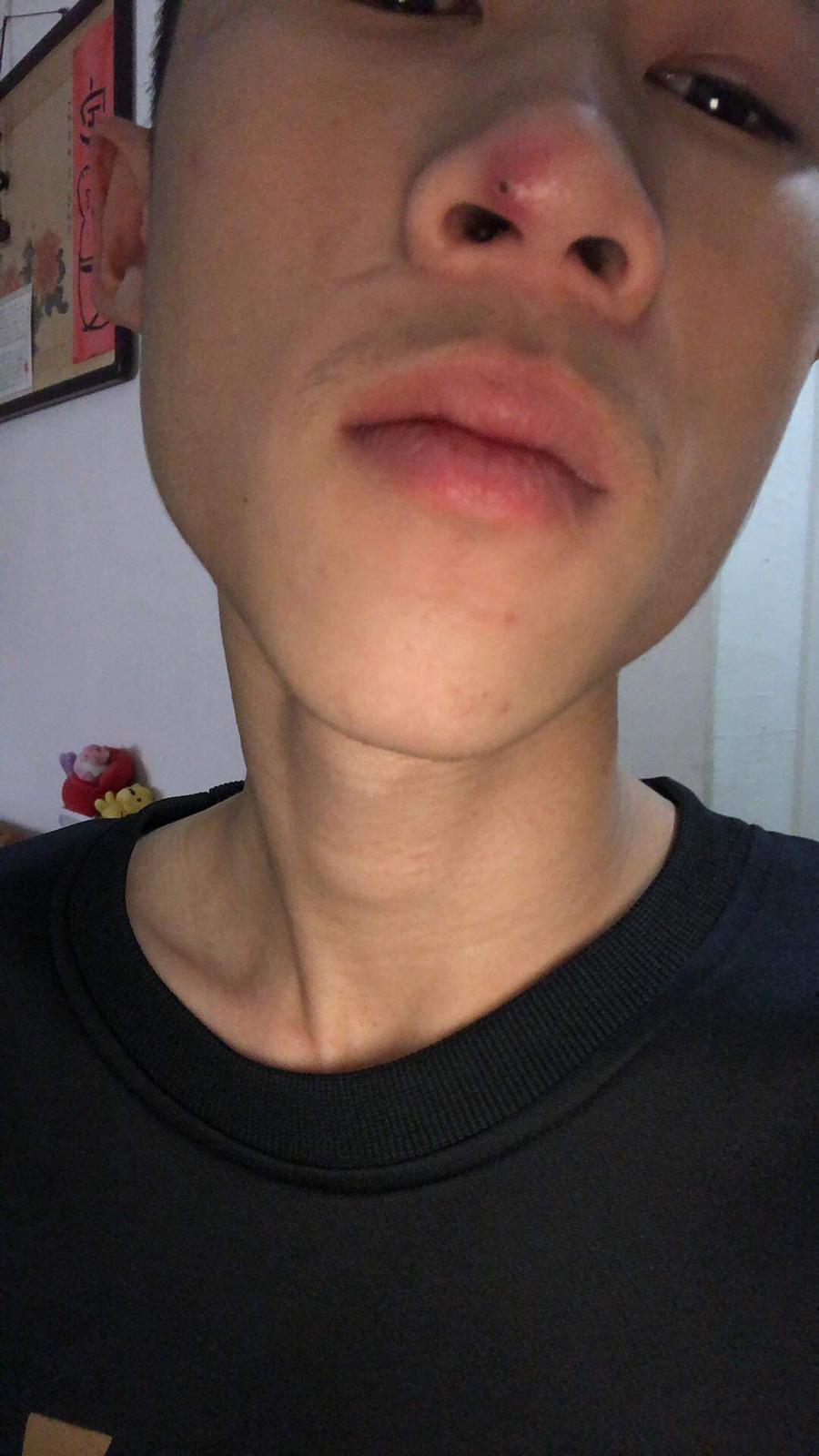 艾文同學因壓力太大免疫力下降，在鼻子長了顆超級怪痘，最後演變成蜂窩性組織炎。（混血兒娛樂提供）