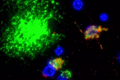 阿茲海默症患者腦組織中的β-澱粉樣蛋白（綠色）和牙齦卟啉單胞菌（紅色）S. DOMINY 等，SCIENCE ADVANCES 5，（2019）（來源：Science Advances）