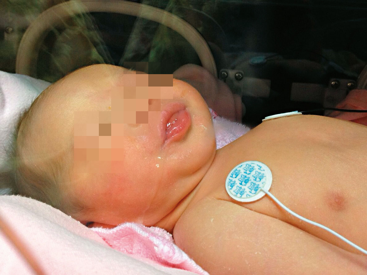 剛出生的大寶因呼吸窘迫，被送入新生兒加護病房，非生母的同性伴侶無法探望。（讀者提供）