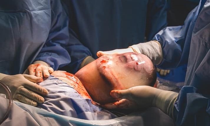 諾亞被羊膜囊包覆出生，畫面震驚許多人。（圖擷自Monyck Valasco臉書）