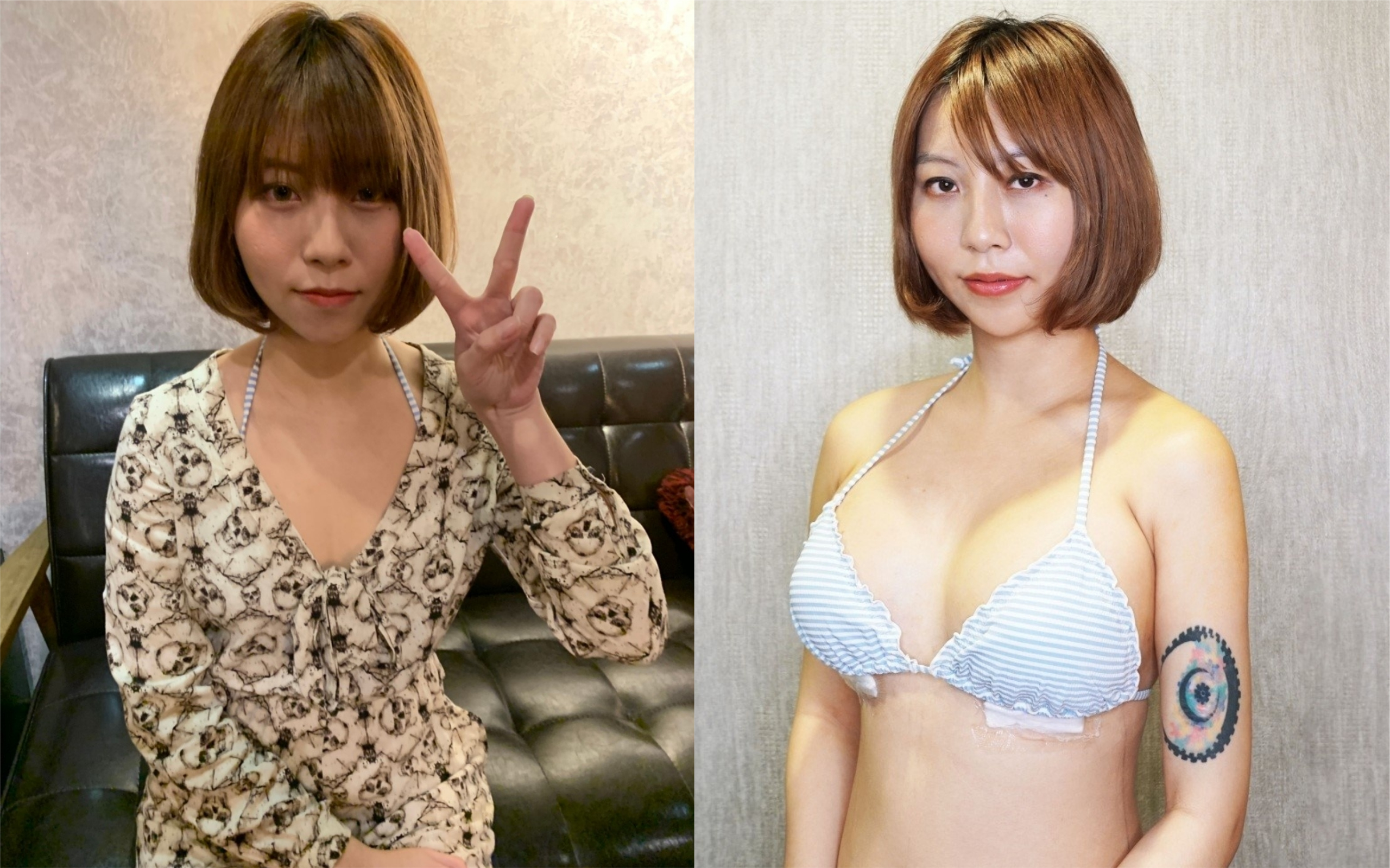 小辣模星諠隆乳初體驗，嬌小平胸的她，術後第一天不但沒有瘀青，也已經有豐滿的好身材，期待一個月後的自然柔軟。