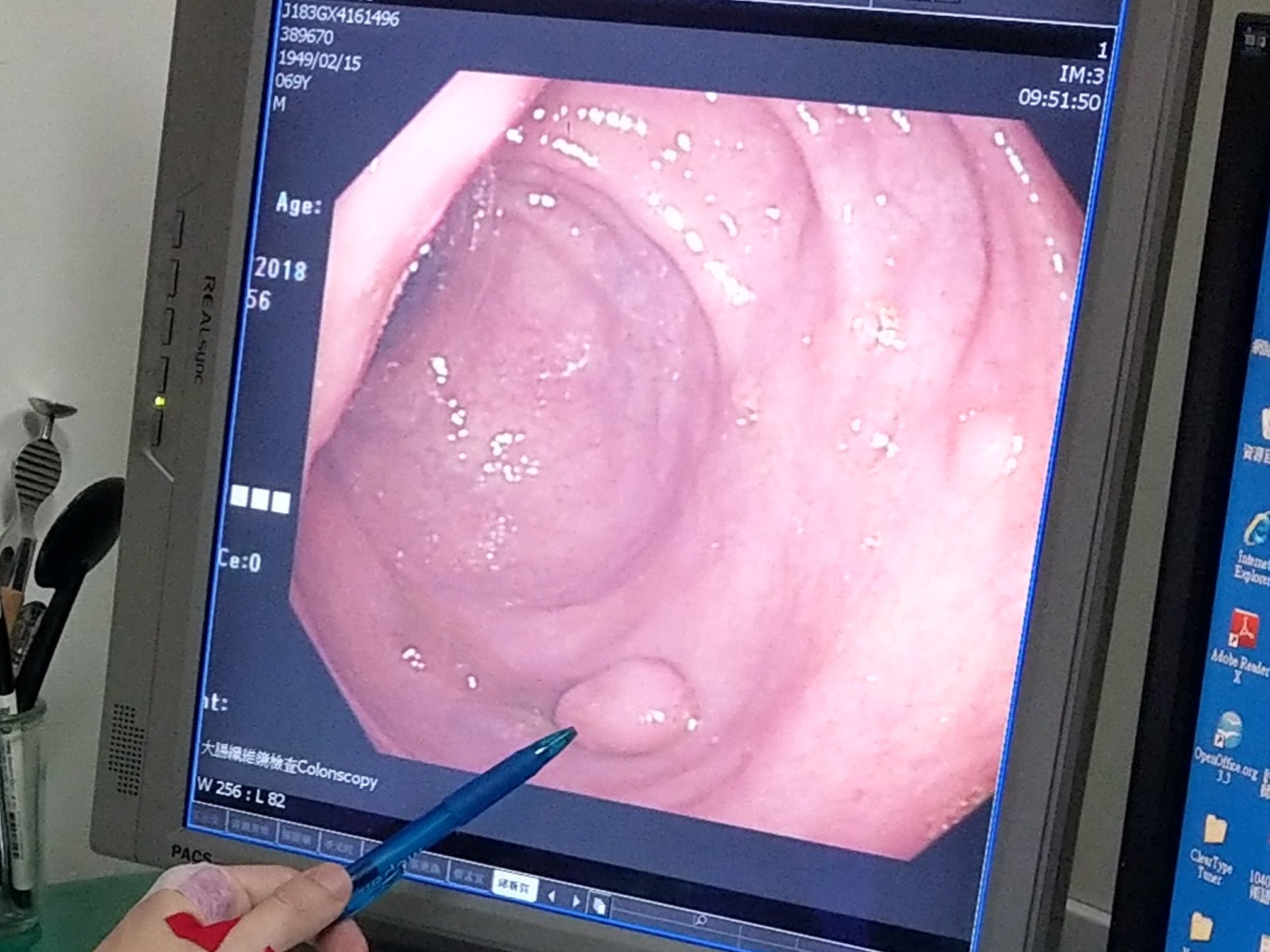 邱男大腸中驗出了3個息肉，醫師建議全家大腸鏡檢查，結果一家7口都驗出息肉。（翻攝自衛生福利部彰化醫院臉書）