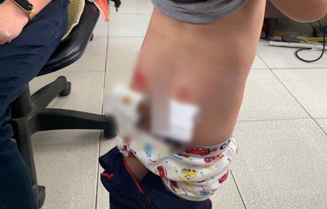 男童臀部有明顯傷痕，讓人十分心疼。（翻攝畫面）