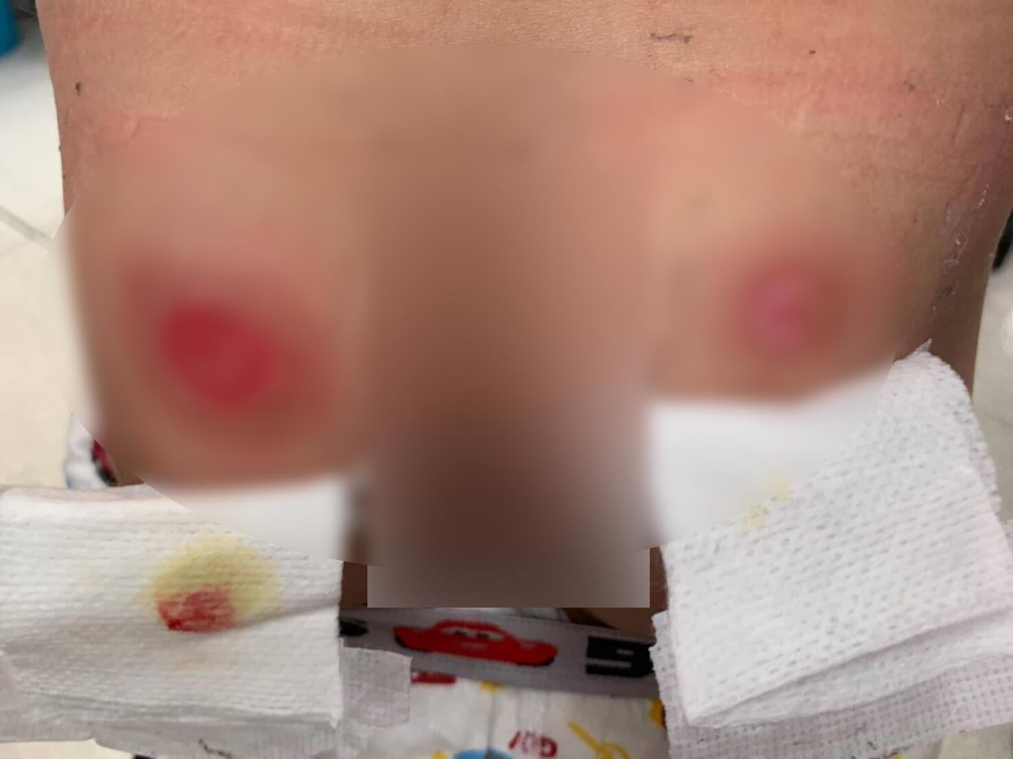 男童臀部左右各有一大一小的傷痕,保母則稱是被稀飯燙傷。(翻攝畫面)