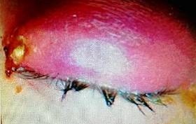 患者遭汗蜂鑽入眼睛，腫如鹹蛋般大小。（翻攝畫面）