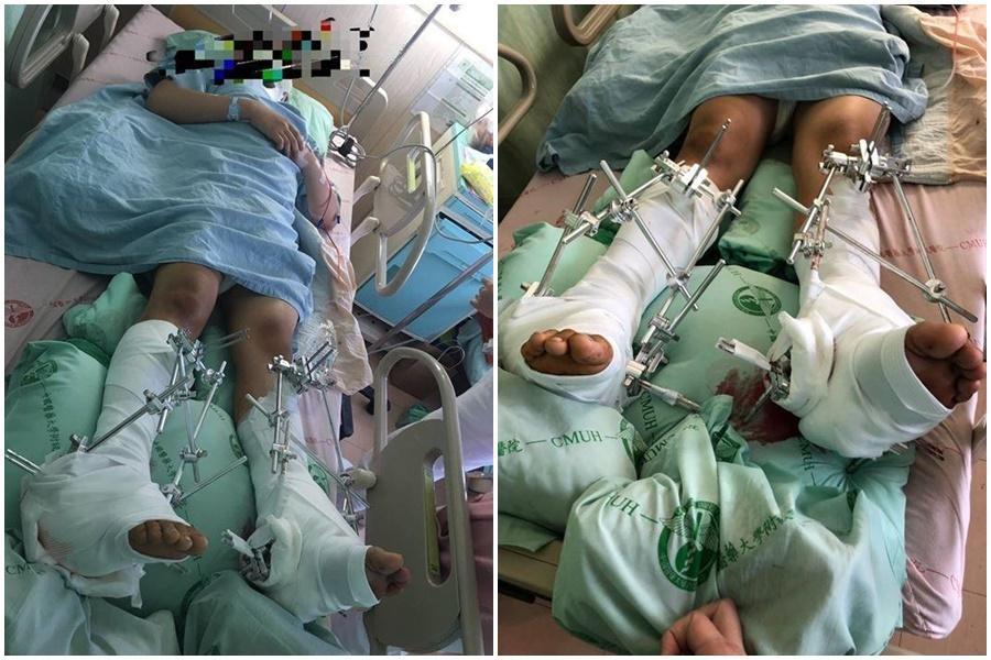 劉姓國三生因不堪長期遭霸凌跳樓，雙腳骨折變形。（翻攝自爆料公社）