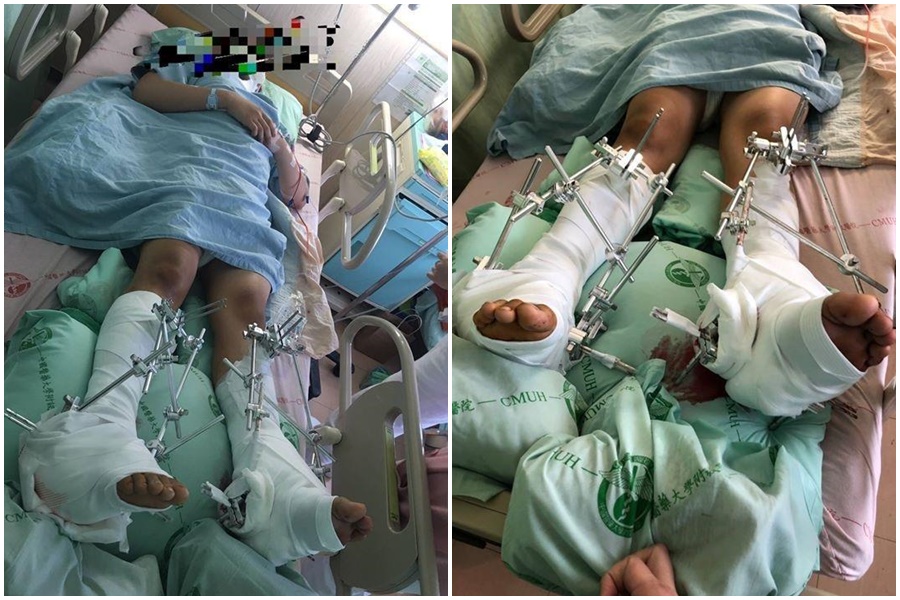 劉姓國三生因不堪長期遭霸凌跳樓，雙腳骨折變形。（翻攝自爆料公社）