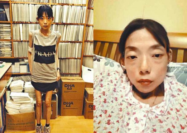 伍智恒在離婚後病情加劇，身高162公分的她更瘦到22公斤。（翻攝自微博）