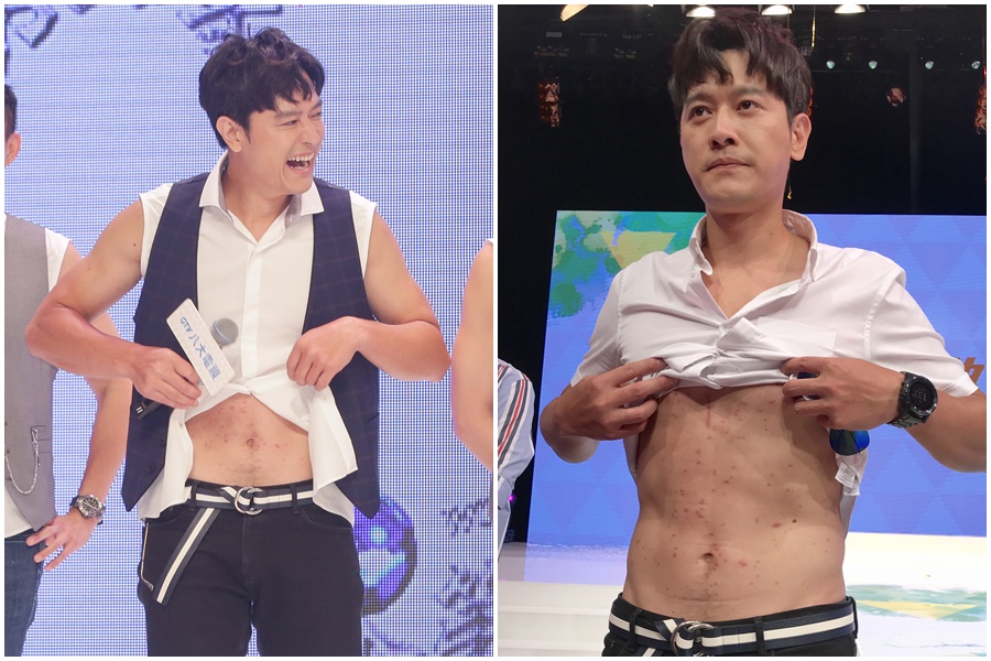 張勛傑掀起上衣，上半身布滿紅疹，相當駭人。