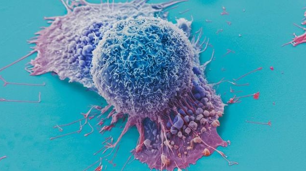 肺癌細胞的掃描電子顯微鏡照片。（來源：ANNE WESTON / FRANCIS CRICK INSTITUTE / WELLCOME ）