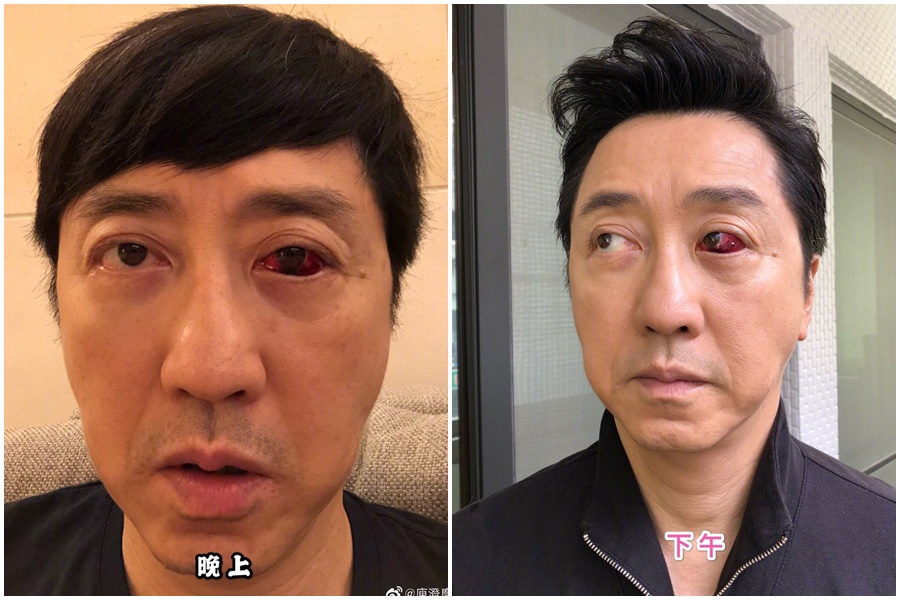 庾澄慶上傳左眼爆血管照片，嚇壞許多粉絲，他也不忘趁機宣傳新作《西哈遊記》。（摘自庾澄慶微博）