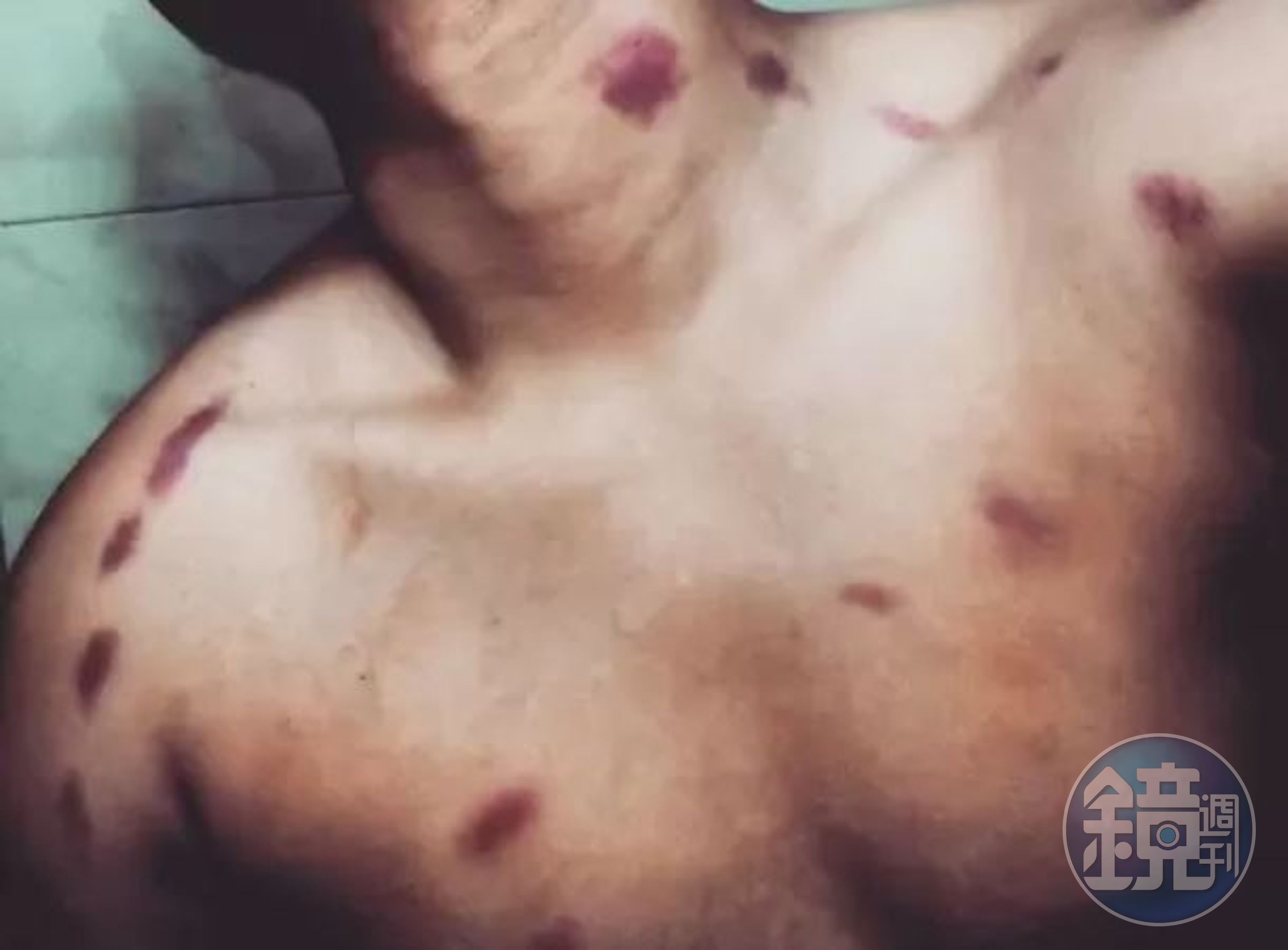 男子親密過後脖子出現多處吻痕，害得他中風身亡，示意圖。（翻攝自網路）