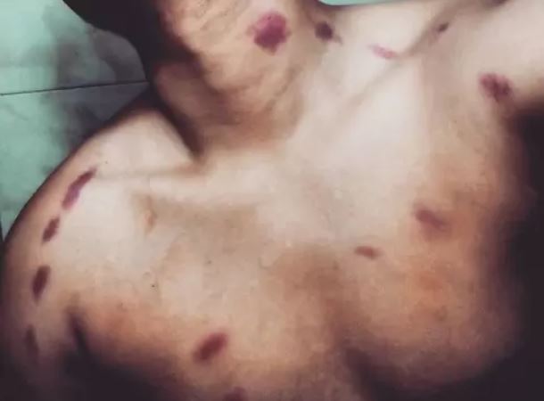 男子親密過後脖子出現多處吻痕，害得他中風身亡，示意圖。（翻攝自網路）