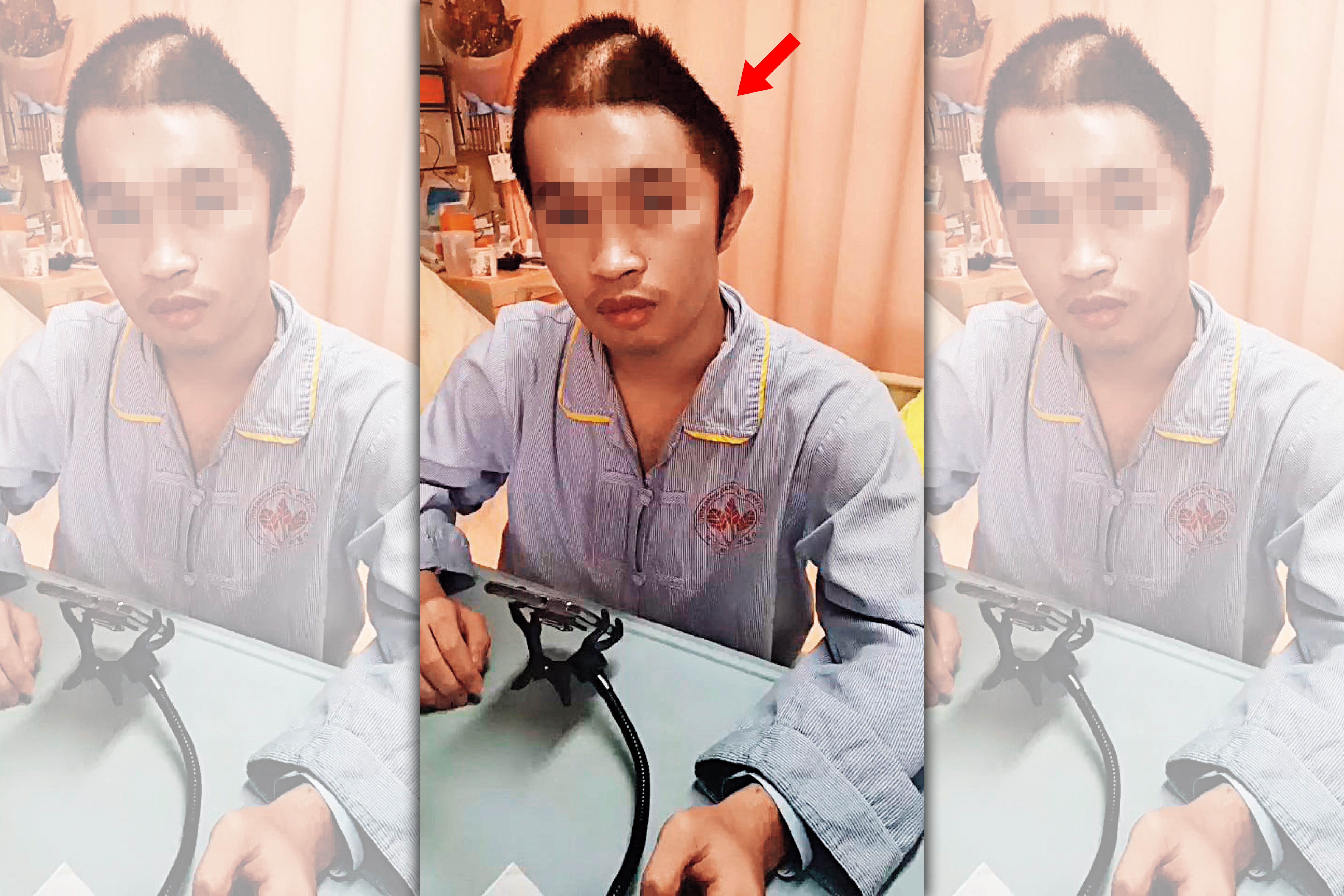 阿瑞（化名）在社團主辦的跨校拳擊交流賽中，頭部嚴重受創，最後開刀取下大片頭蓋骨治療，保住一命。（翻攝畫面）