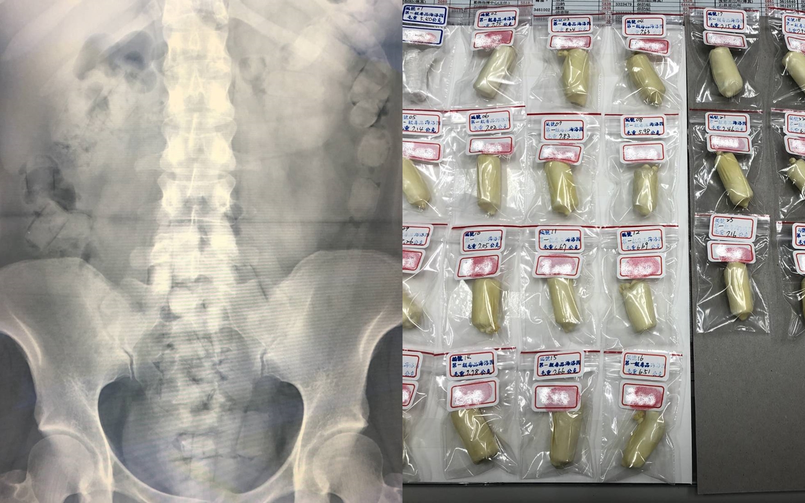 女子人體運毒，X光可見腹腔內滿是海洛因毒球。（翻攝照片）