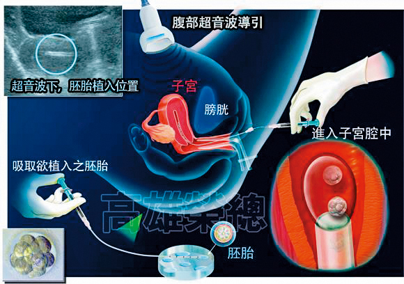 試管嬰兒就是體外受精，胚胎移植技術的俗稱，圖為試管嬰兒術流程。（翻攝高雄榮總婦女醫學部生殖醫學中心網站）