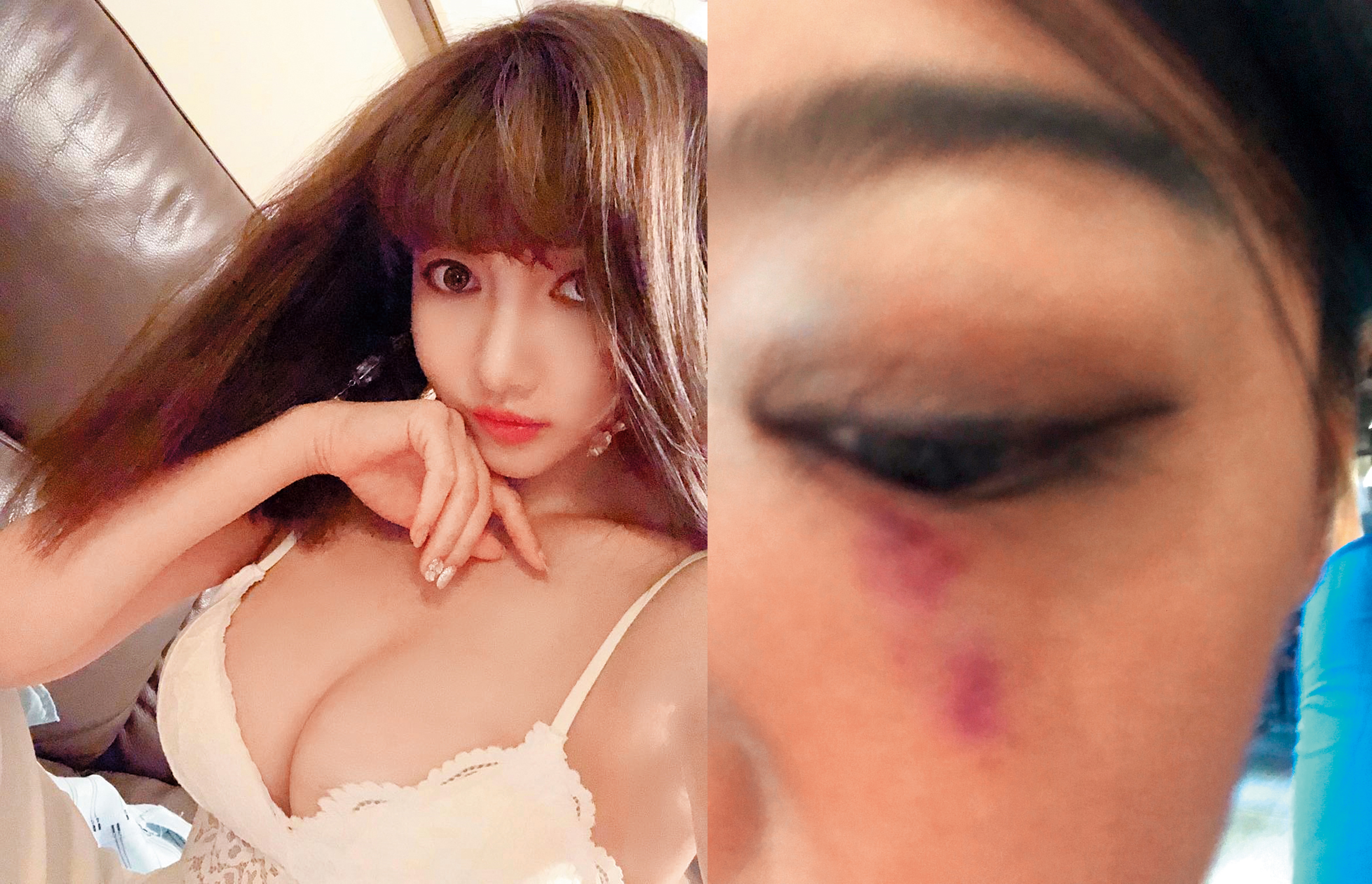 7月18日開庭時，李小姐（右）被屁蛋妹（左）拿手機砸傷眼，當天立刻去驗傷又告她一條傷害罪。（左圖翻攝kkeellyyttssaaii IG，右圖讀者提供）