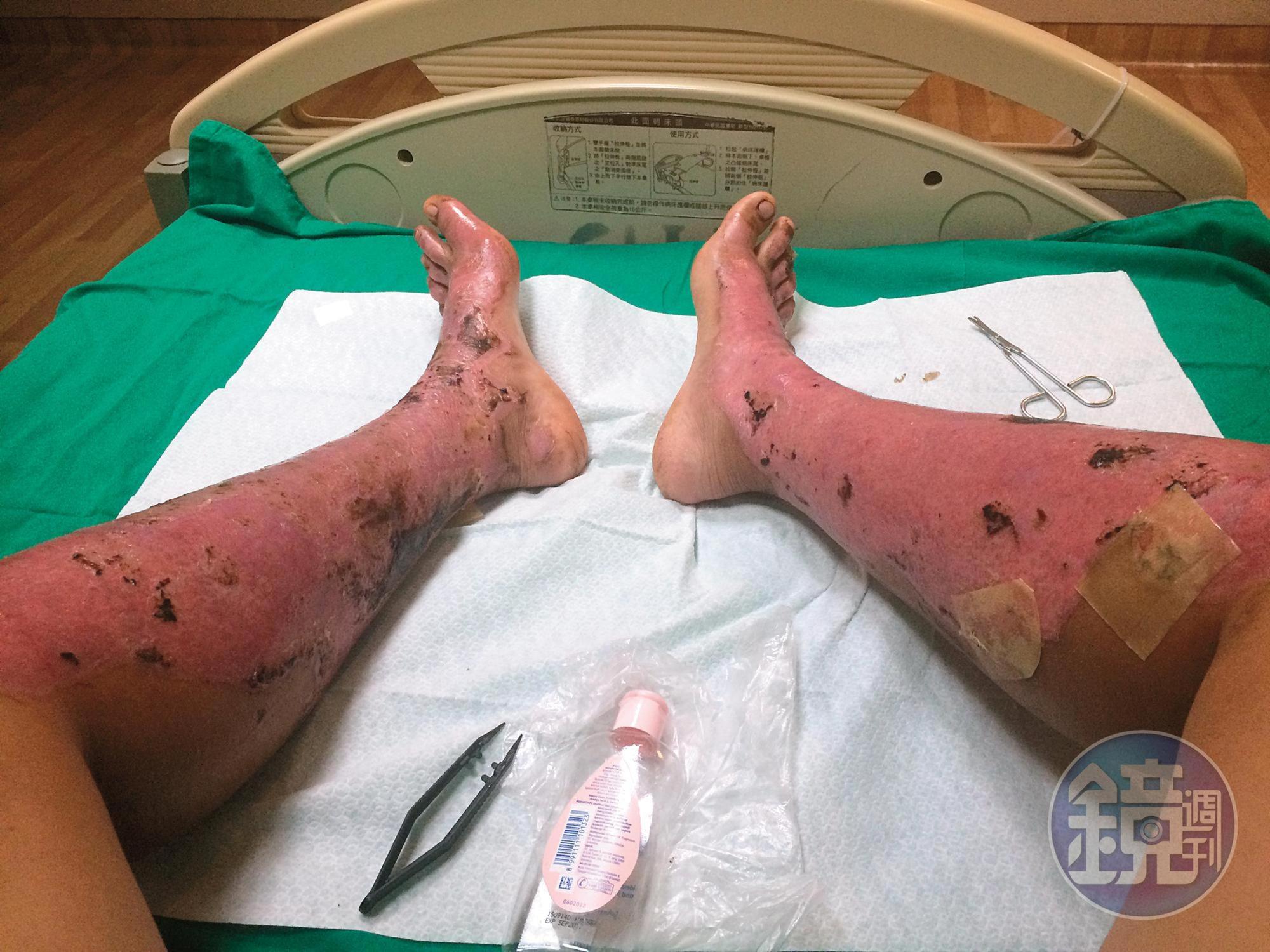 八仙塵爆時,手部1、2度灼傷,不算嚴重,但腿部是深2、3度灼傷,後續復健過程中,幾度痛得黃逸柔大哭大叫。(黃逸柔提供)