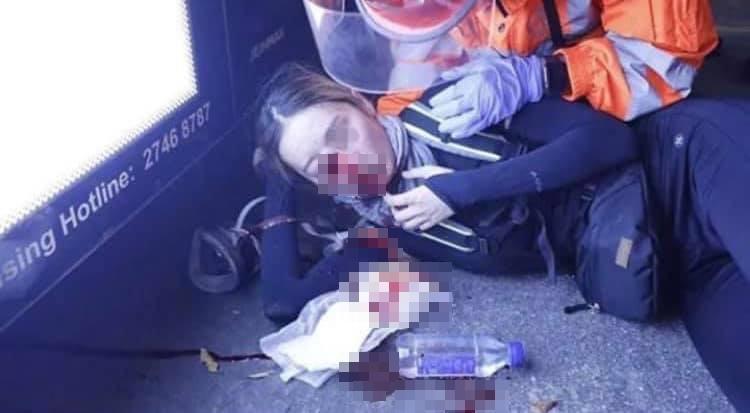 少女遭港警以布袋彈射眼，護目鏡也遭射穿，當場血流如注。（翻攝自Narziss Tang臉書）