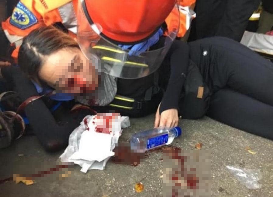 少女眼部遭襲擊，導致右眼失明。（翻攝桑普臉書）