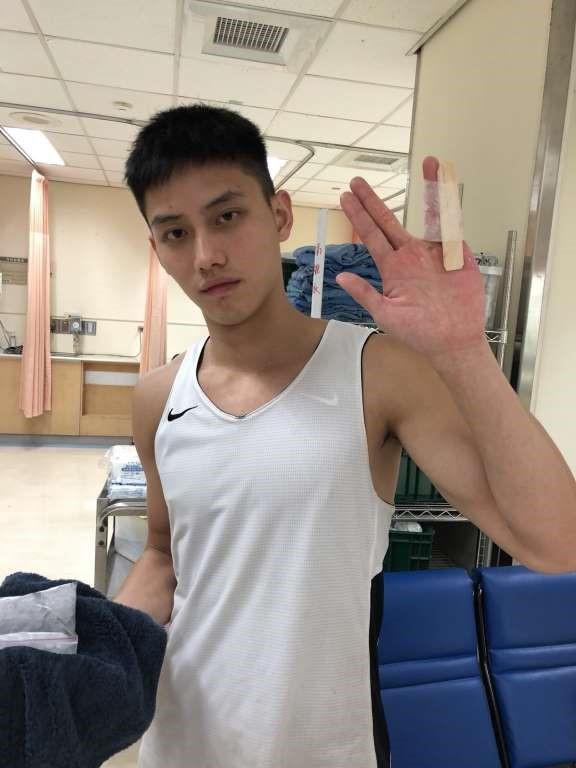 范少勳拍片時左手小拇指因碰撞脫臼變形。（范少勳提供）