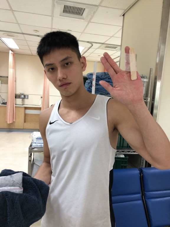 范少勳拍片時左手小拇指因碰撞脫臼變形。（范少勳提供）