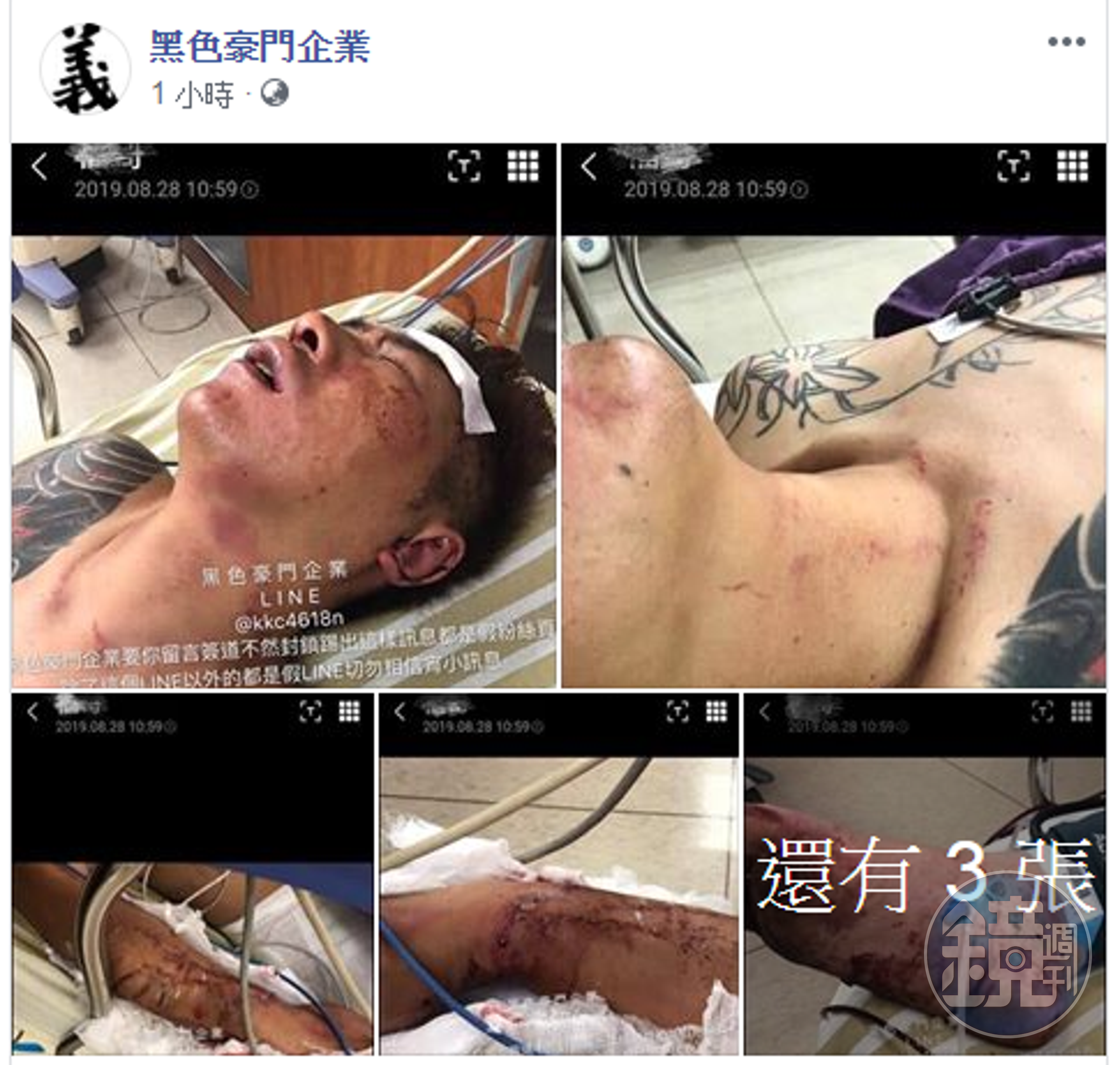 臉書專頁曝光吳小哲的傷勢照片，不少粉絲懷疑是同業下的手。（翻攝黑色豪門企業臉書）