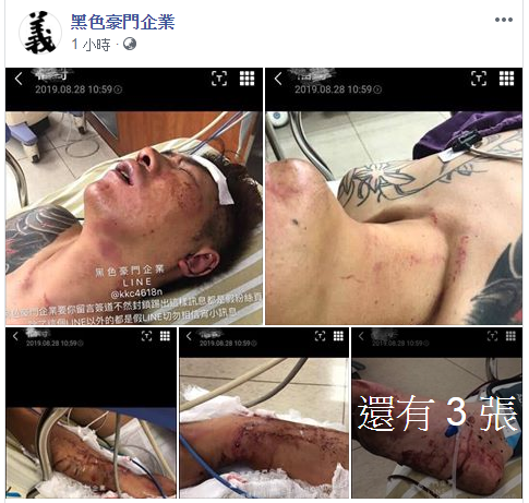 臉書專頁曝光吳小哲的傷勢照片，不少粉絲懷疑是同業下的手。（翻攝黑色豪門企業臉書）