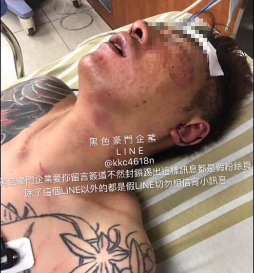 臉書專頁曝光吳小哲在醫院傷勢嚴重的照片。（翻攝黑色豪門企業）