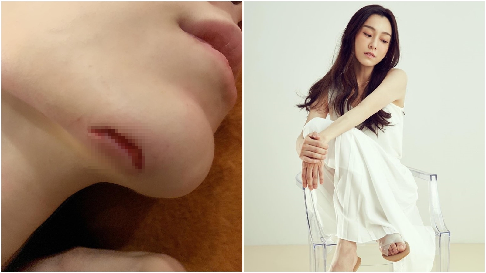 范范凌晨摔傷，緊急送醫處理縫了15針。（合成圖，翻攝范瑋琪Instagram、臉書）