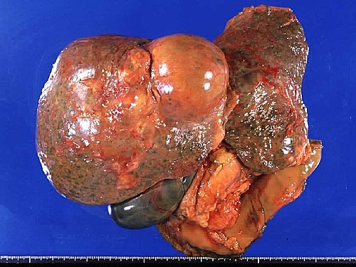 現代人的飲食習慣也是罹患肝癌的主因之一。(非當事人照片)