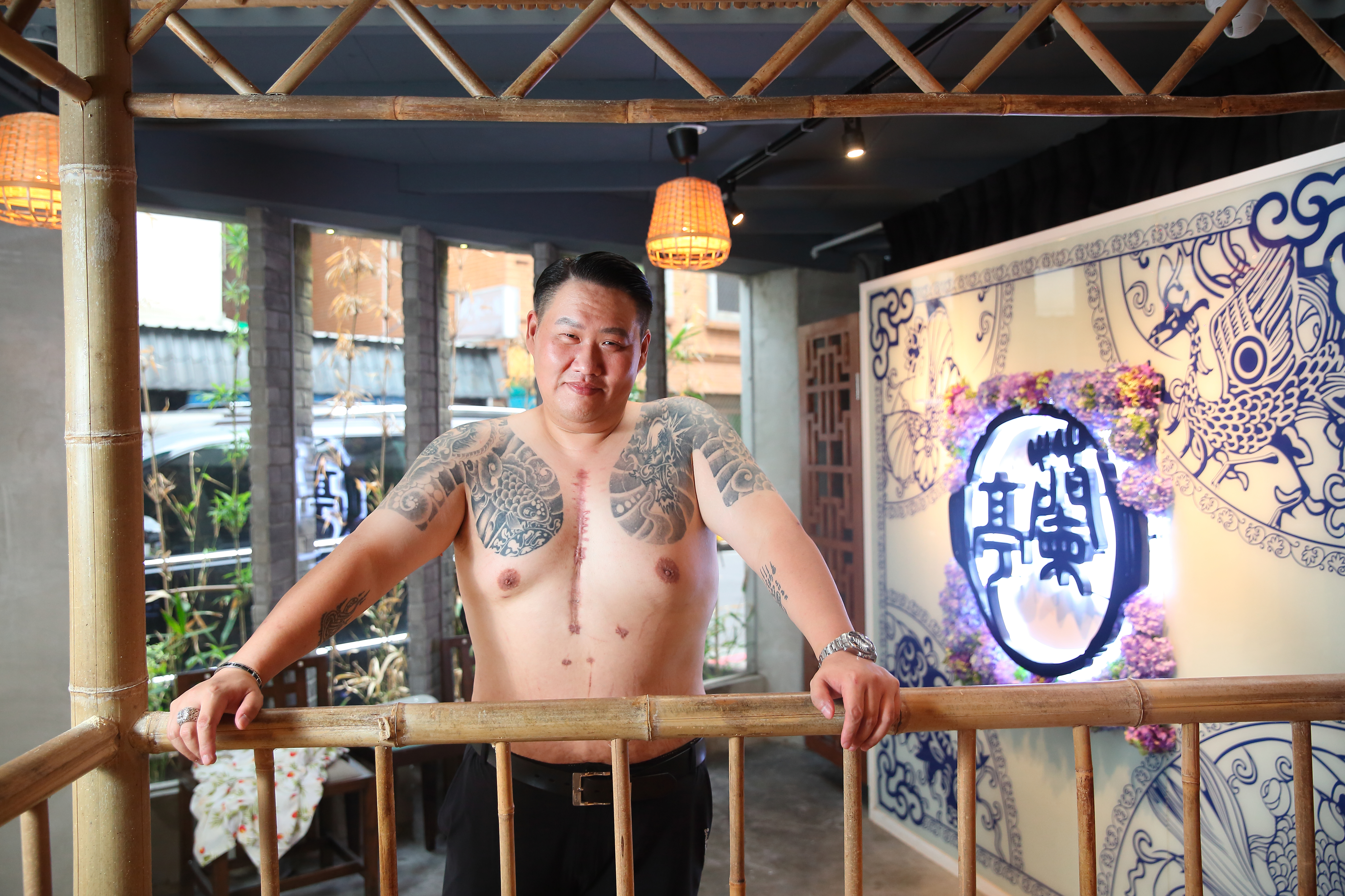 蘭小明的胸前有一條約20公分的疤，那是4年前他因心臟血管阻塞開刀留下。