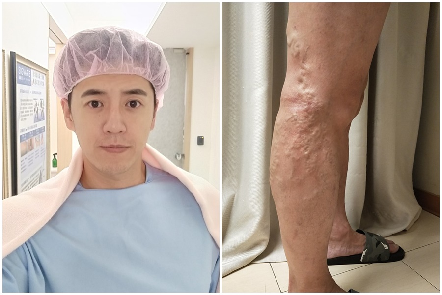 藝人阿布分享自己有遺傳性的靜脈曲張。（翻攝自阿布&米雪兒幸福布二家臉書）