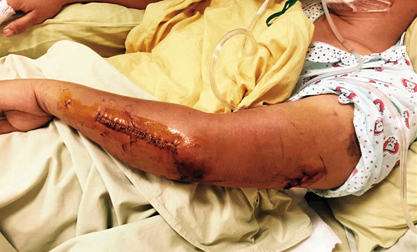 謝女(圖)被沈聯旺打得全身傷痕累累,失血過多,差點沒命。(東森新聞提供)