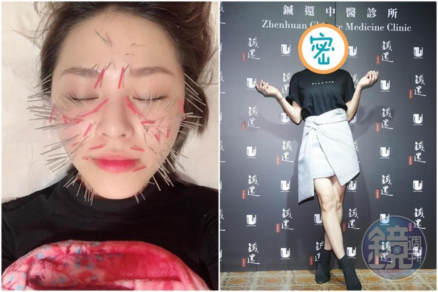 33歲女星熊熊爛下巴以為是皮膚病,竟被醫生指出是婦科疾病,為了愛美更常做臉鍼拉提,不怕臉扎滿針。