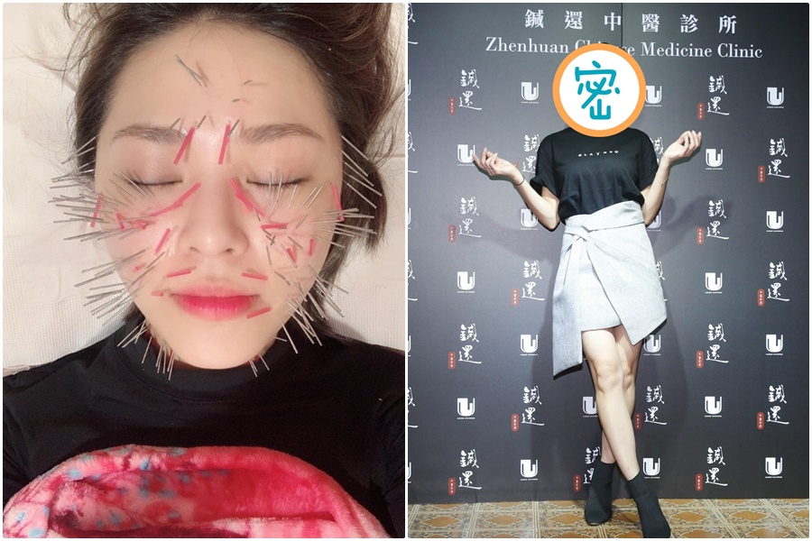 33歲女星熊熊爛下巴以為是皮膚病，竟被醫生指出是婦科疾病，為了愛美更常做臉鍼拉提，不怕臉扎滿針。