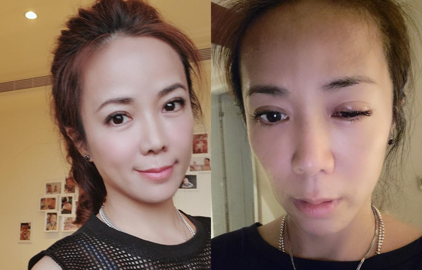 陳仙梅眼睛腫如核桃,依舊心繫兒子的萬聖節活動,讓她覺得自己不夠愛自己。(翻攝自陳仙梅臉書)